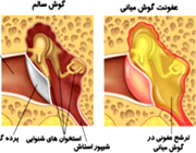 عفونت گوش میانی 